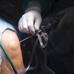 Que es artroscopia de rodilla